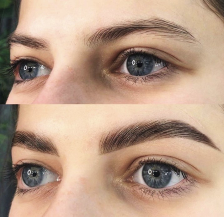 Brow Lifting